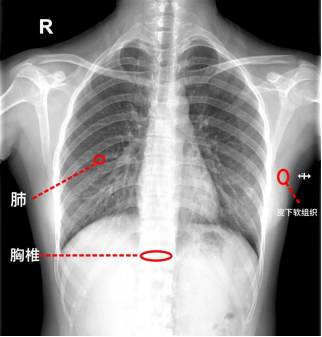 X线、CT、磁共振有何区别?看这一篇你就懂了