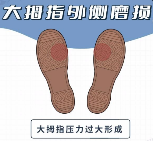 身体好不好,看鞋就知道?提醒:鞋底穿成4个模样,该留意了
