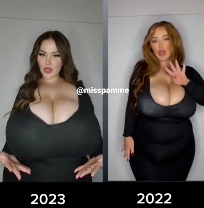 女子双胸重约25斤,确诊“巨乳症”!什么是巨乳症?怎么治疗?