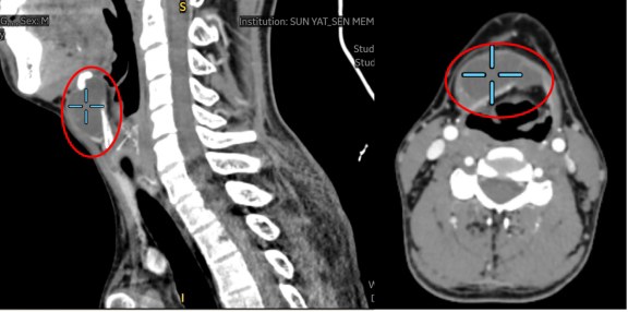双重“打击”！年轻男子发现2个颈部肿物 经口机器人手术实现无痕祛病