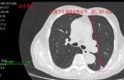 一家三人患肺癌 专家提醒高危人群要这样做