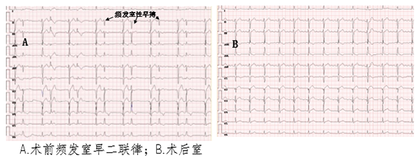 36岁男子室性早搏,酒精妙用助力完成消融治疗