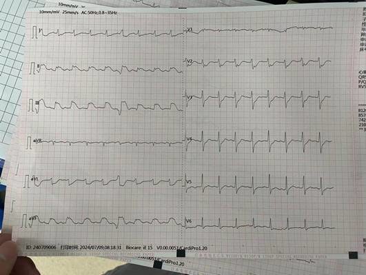 7.9 -2  抢救回来后的心电图，提示下壁心梗
