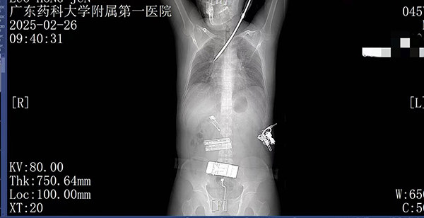 20米高空掉落30cm长螺丝刀直插男子胸腔，广药大附一院多学科成功抢救