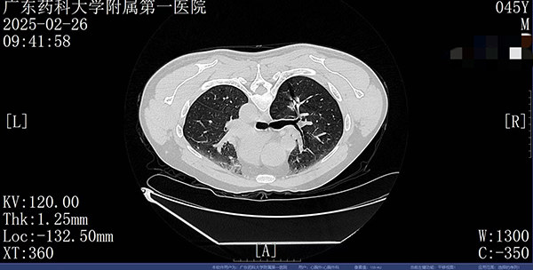 20米高空掉落30cm长螺丝刀直插男子胸腔，广药大附一院多学科成功抢救