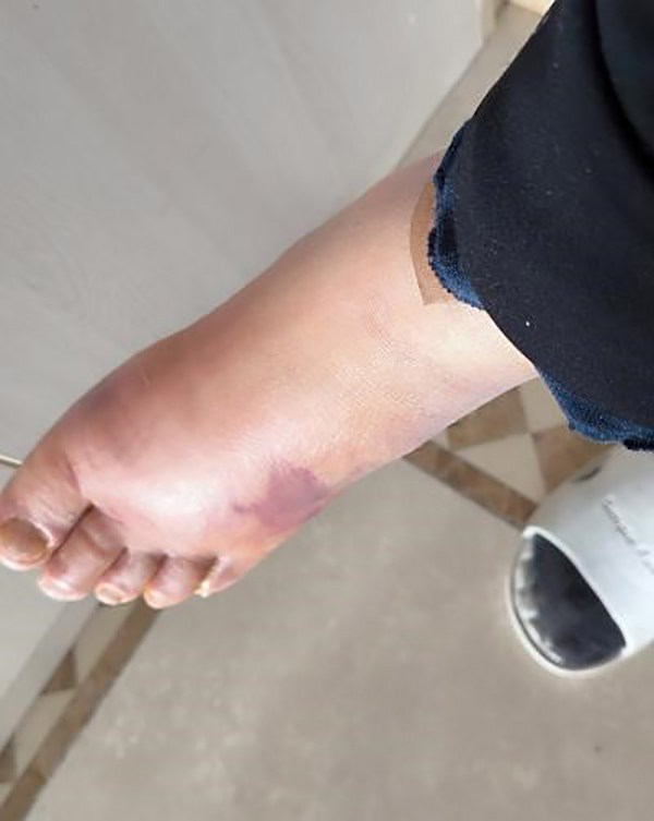 糖尿病阿叔脚背红肿4天迅速恶化，红会医院“保肢天团” 力挽狂澜