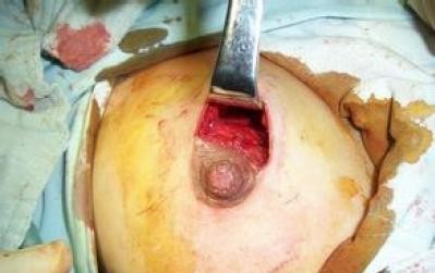 乳房良性纤维瘤图片