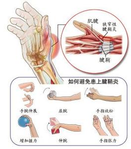 半腱肌肌腱炎图片