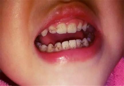 宝宝牙齿长斑图片图片