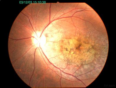 老年性黄斑变性的症状图片,老年性黄斑变性图片大全_老年性黄斑变性