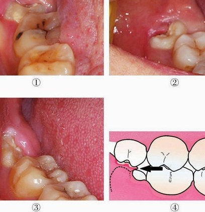 冠周炎可发生在任何萌出阶段的牙齿,但由于下颌智齿的特殊解剖关系,其