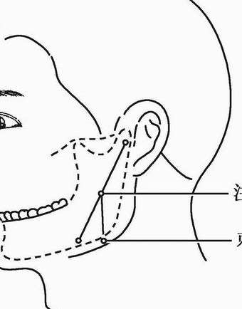 【图】阻滞麻醉法:上牙槽后神经,腭前,上颌,下牙槽神经注射