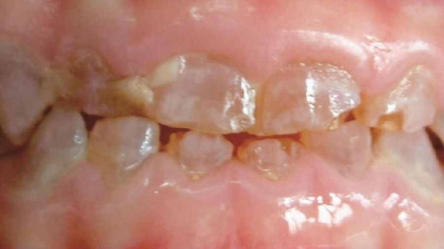 遗传性牙本质发育不全图片