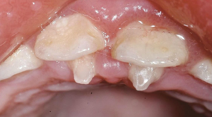 在舌侧窝内陷的基础上,舌隆突呈圆锥形突起形成一小牙尖(图12