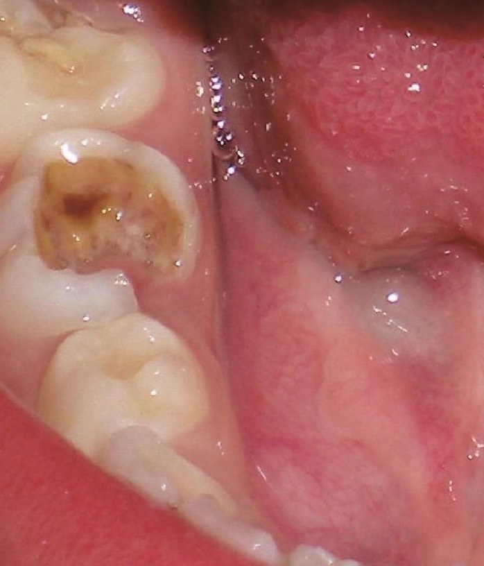 第二磨牙蛀牙图片