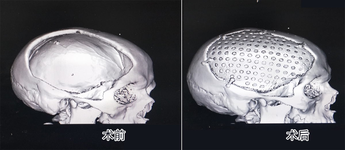 男子脑出血术后颅骨缺损合并脑室穿通畸形穆苍山peek颅骨修复一并解决