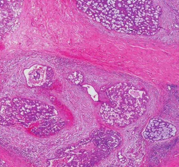 【图】低度恶性筛状囊腺癌详细图解（唾液腺恶性肿瘤的临床病理）