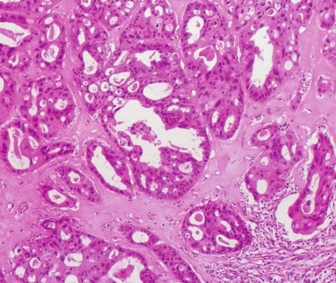 唾液腺导管癌图片