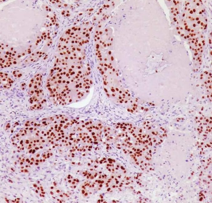 唾液腺导管癌图片