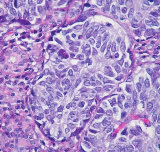 小细胞癌图片特点图片