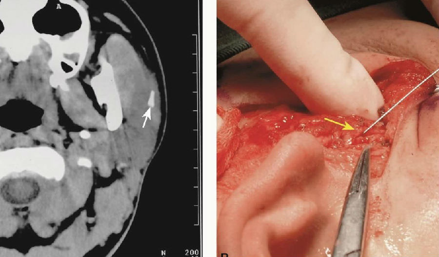 轴位ct图像显示右腮腺导管结石(↑),位于咬肌表面;b在内