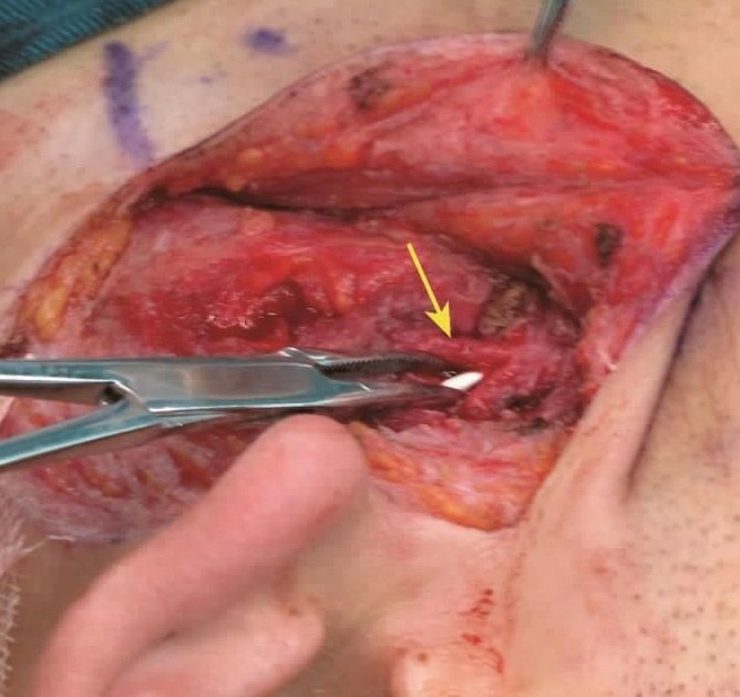 轴位ct图像显示右腮腺导管结石(↑),位于咬肌表面;b