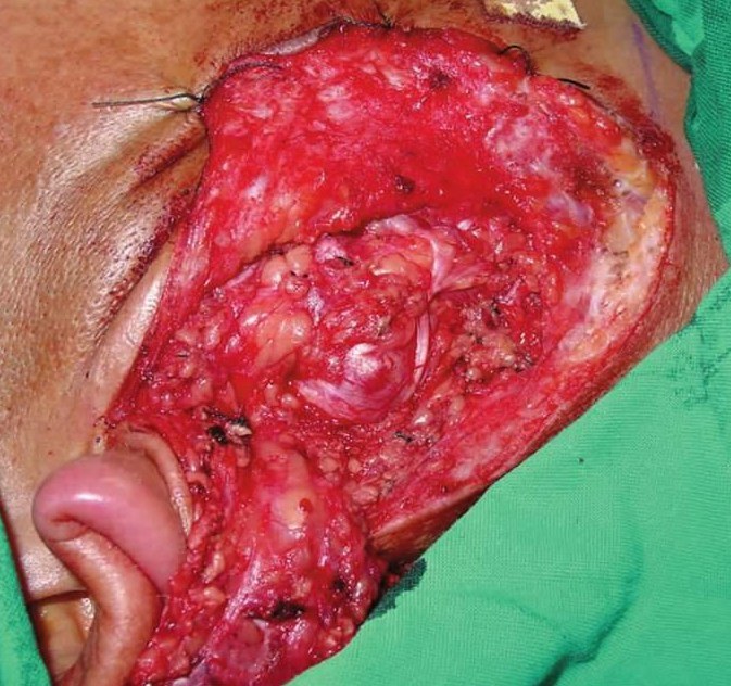 唾液腺囊肿 手术图片