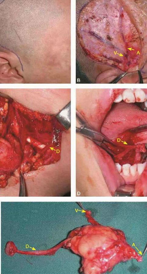 颌下腺结石手术图片