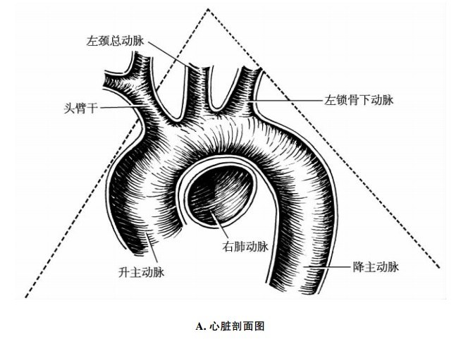 主动脉弓三型图解图片