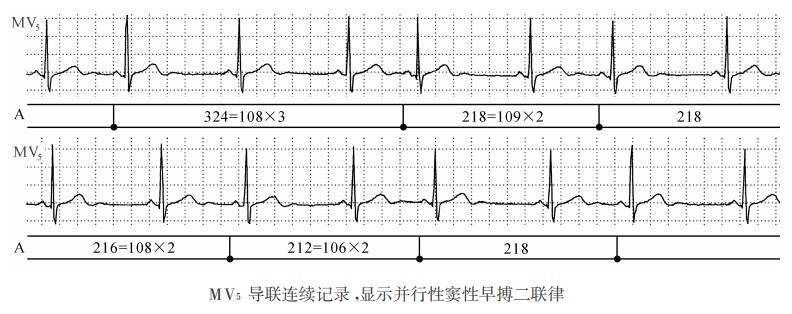 窦性心律心电图特点图片