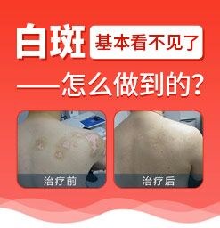 如果您還有問題,可以詳細瞭解一下>只在鄭州西京醫院照308激光,可以嗎