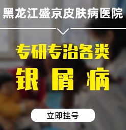 哈尔滨哪里医院看银屑病正规