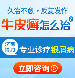 潍坊牛皮癣医院怎么样