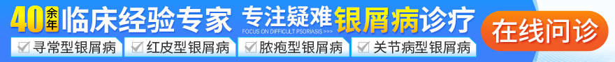 上海江城牛皮癣医院