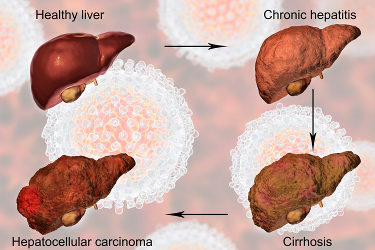 肝臟經歷慢性肝炎,肝硬化,最後演變成肝細胞癌.|圖:originoo.com