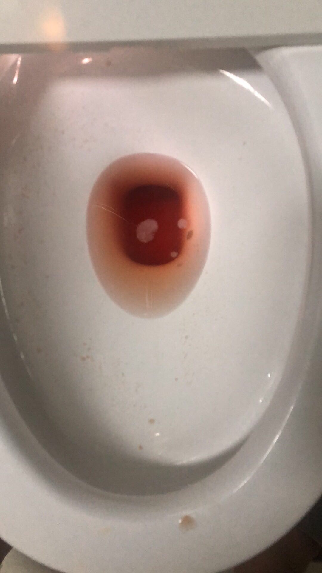 全程尿血持续两天无痛尿少