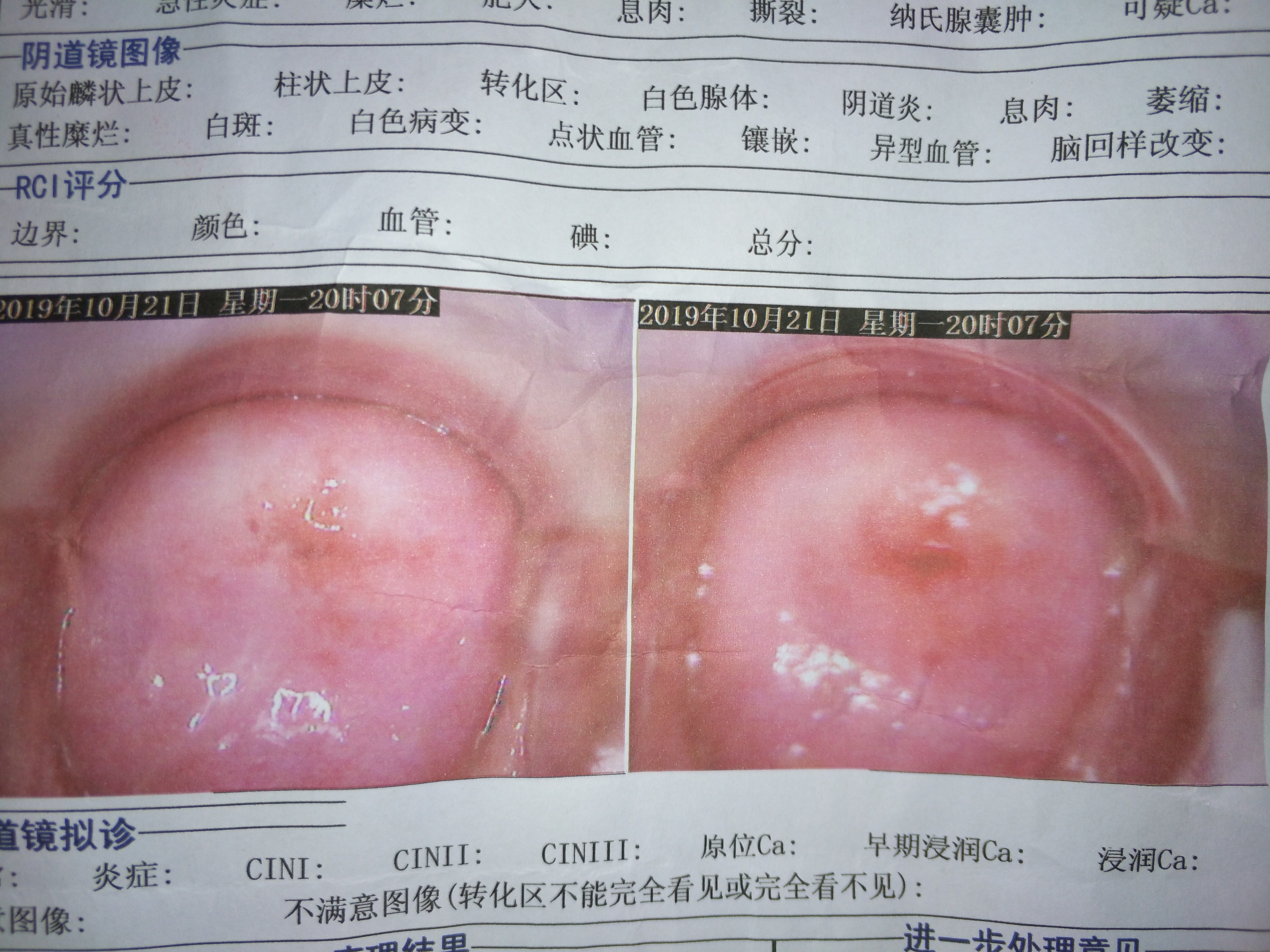 这样的宫颈有炎症吗？严重吗？第二个比较