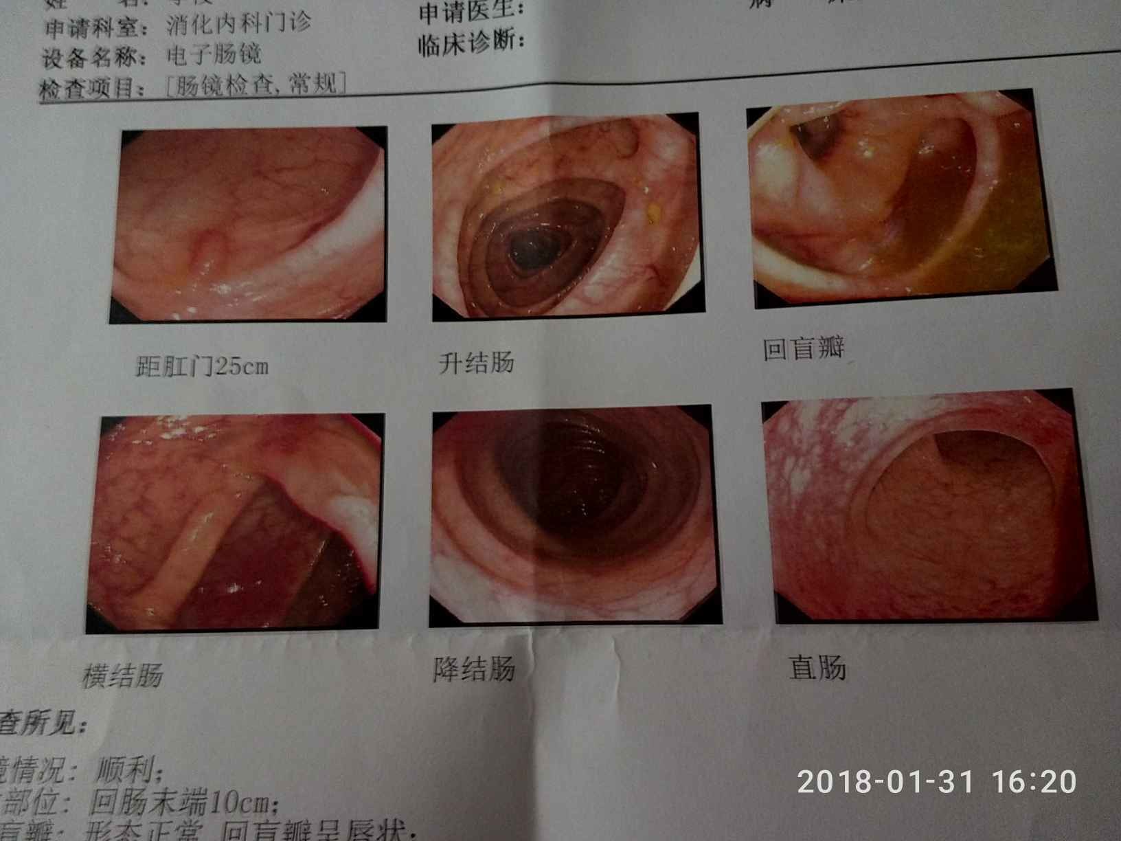 18年肠镜查出乙状结肠息肉0.4cm*