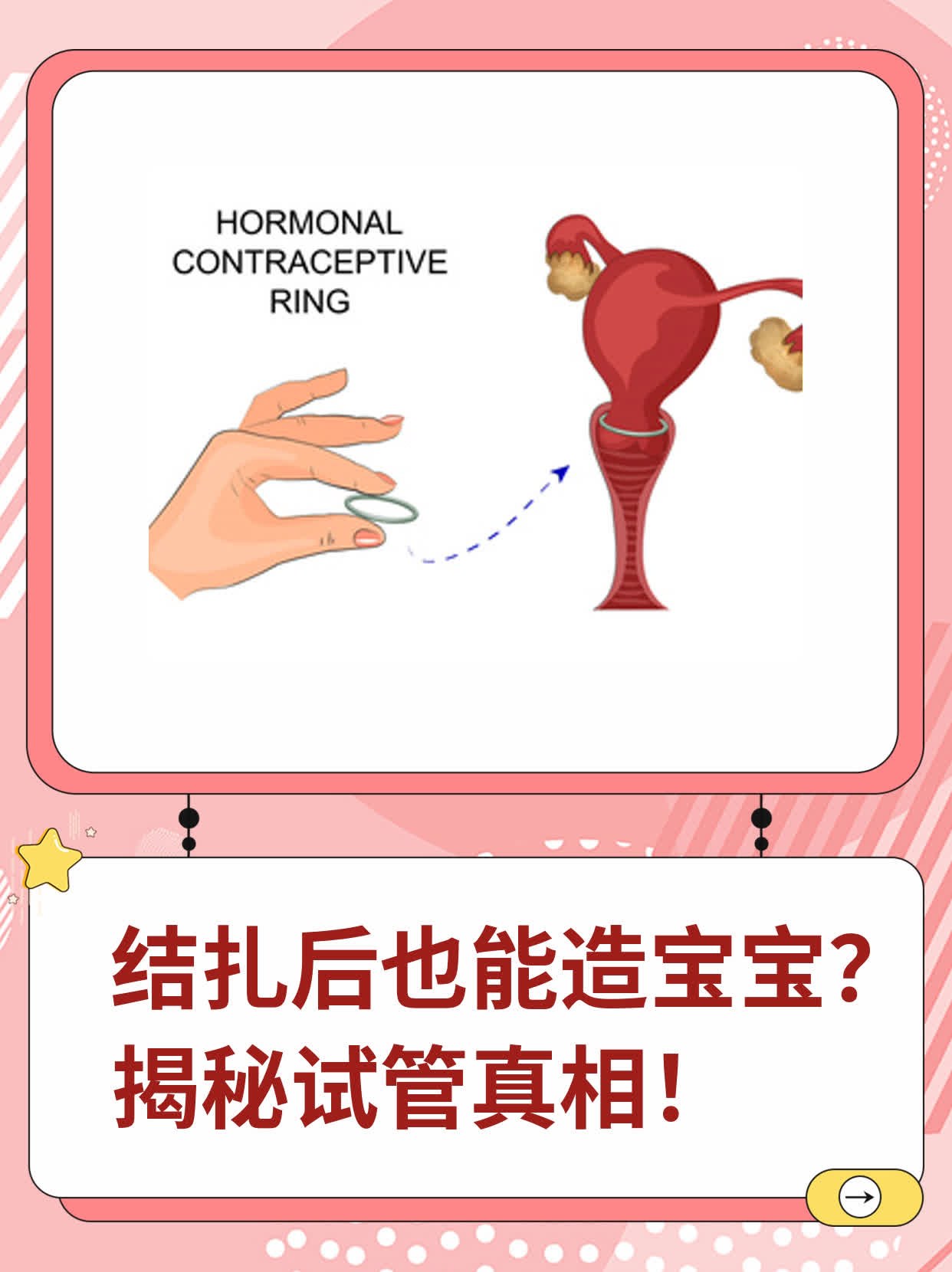结扎了还能做试管婴儿