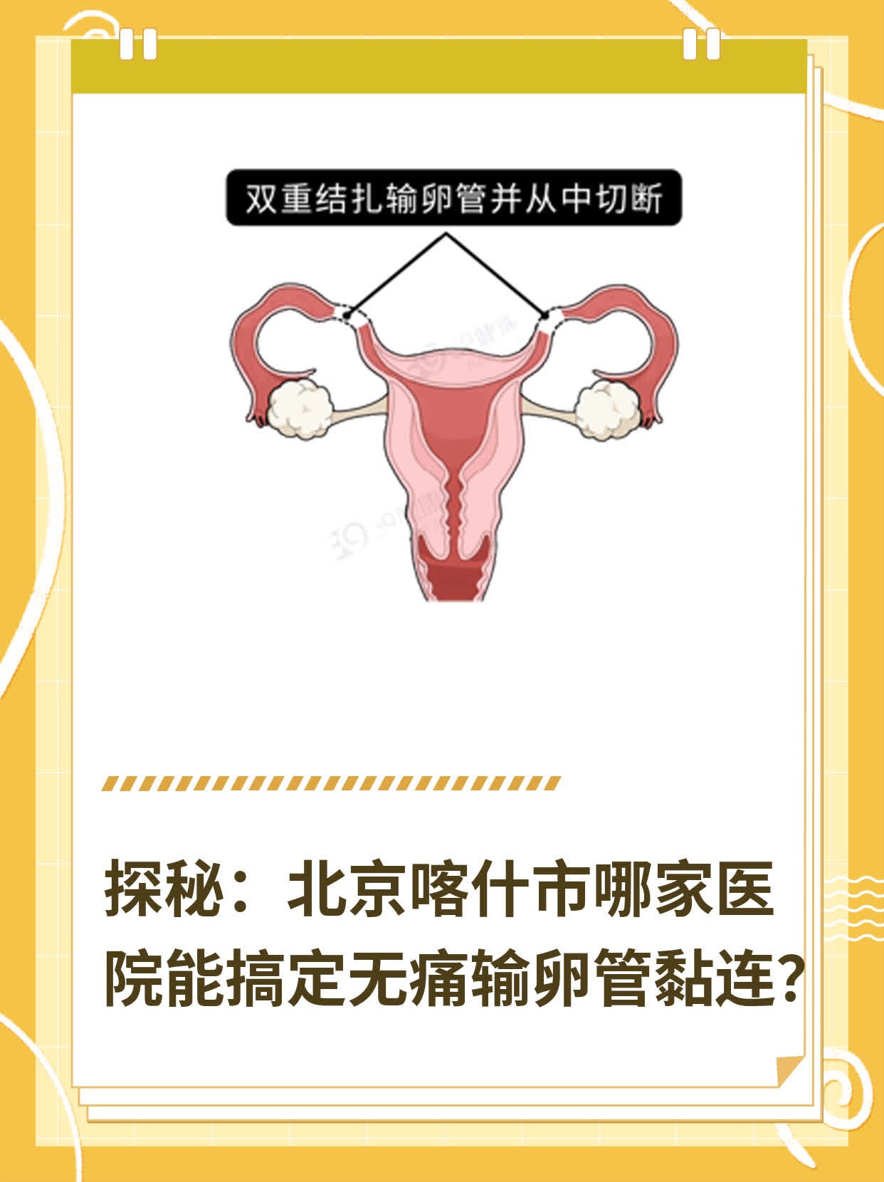 探秘：北京喀什市哪家医院能搞定无痛输卵管黏连？