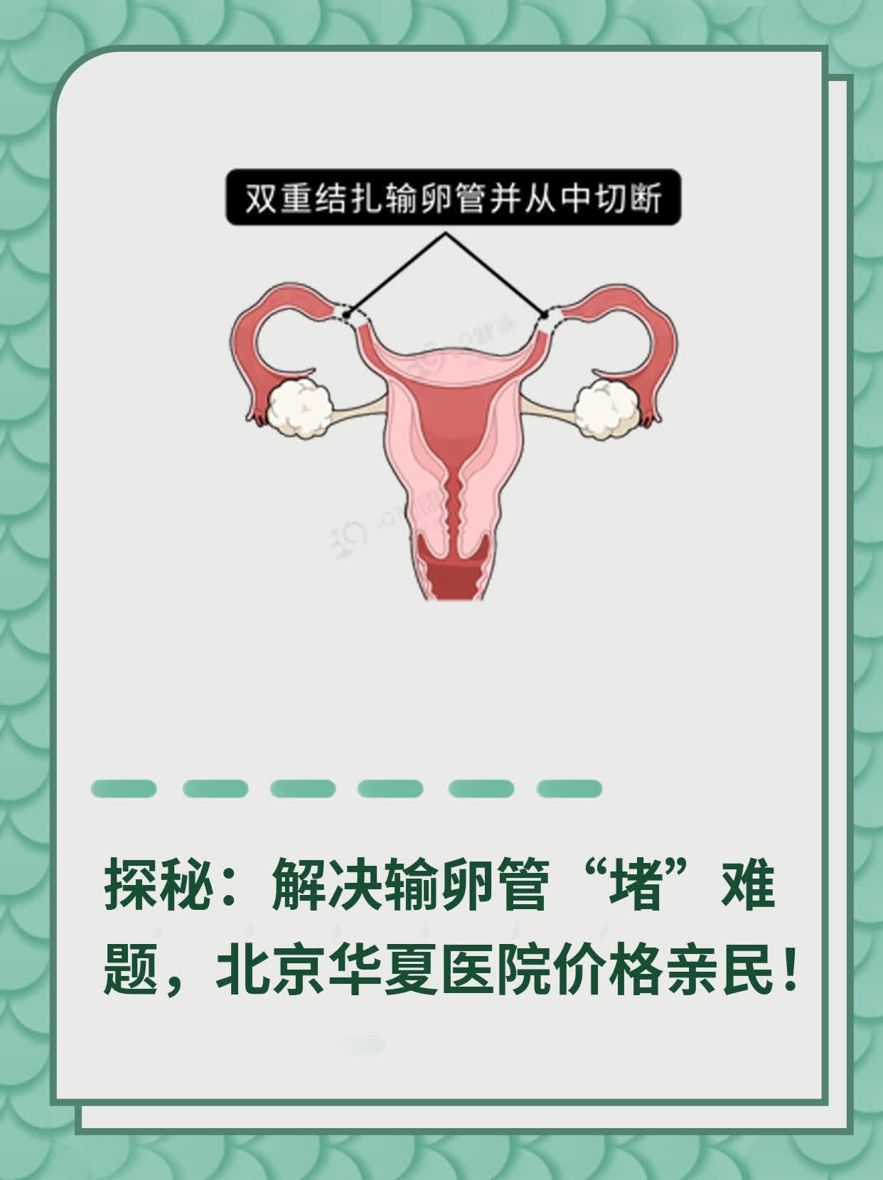 探秘：解决输卵管“堵”难题，北京华夏医院价格亲民！
