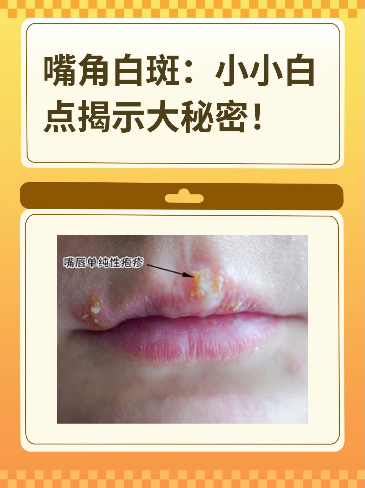 嘴角白斑：小小白点揭示大秘密！