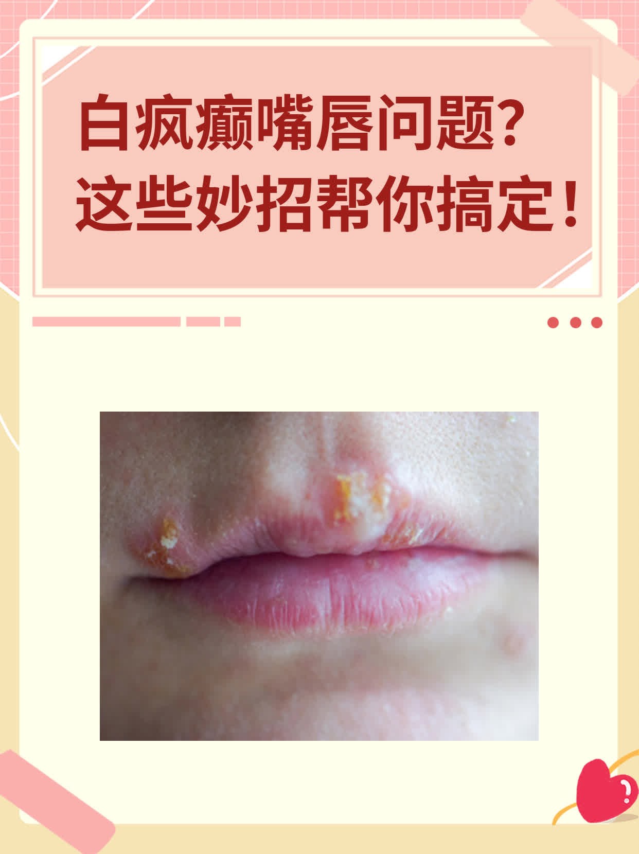 白疯癫嘴唇问题？这些妙招帮你搞定！