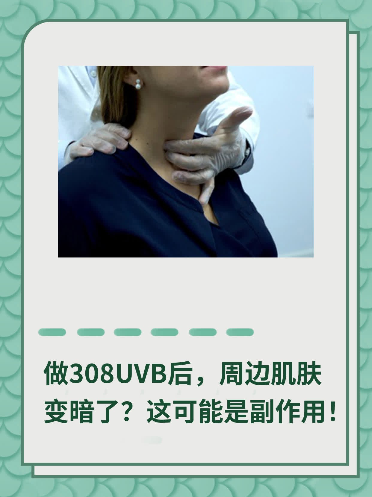 做308UVB后，周边肌肤变暗了？这可能是副作用！