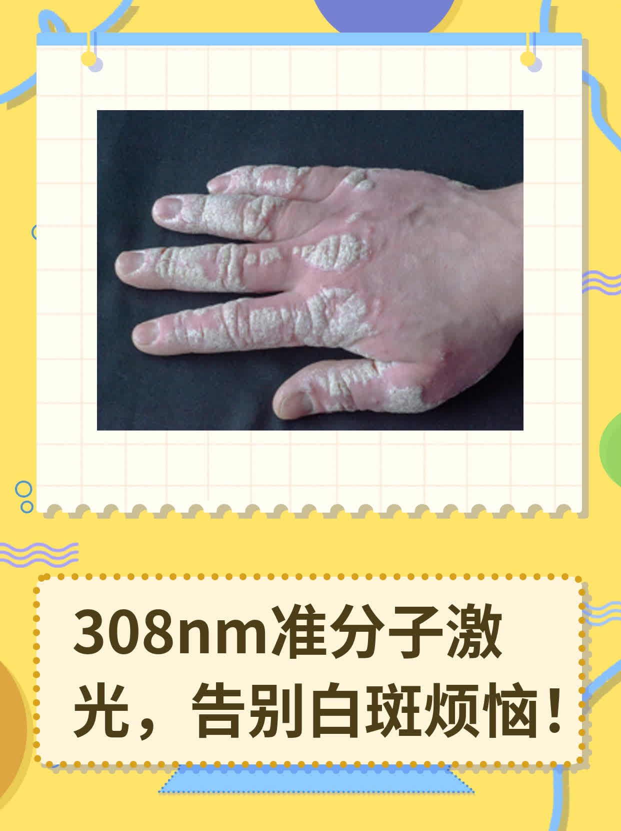 308nm准分子激光，告别白斑烦恼！