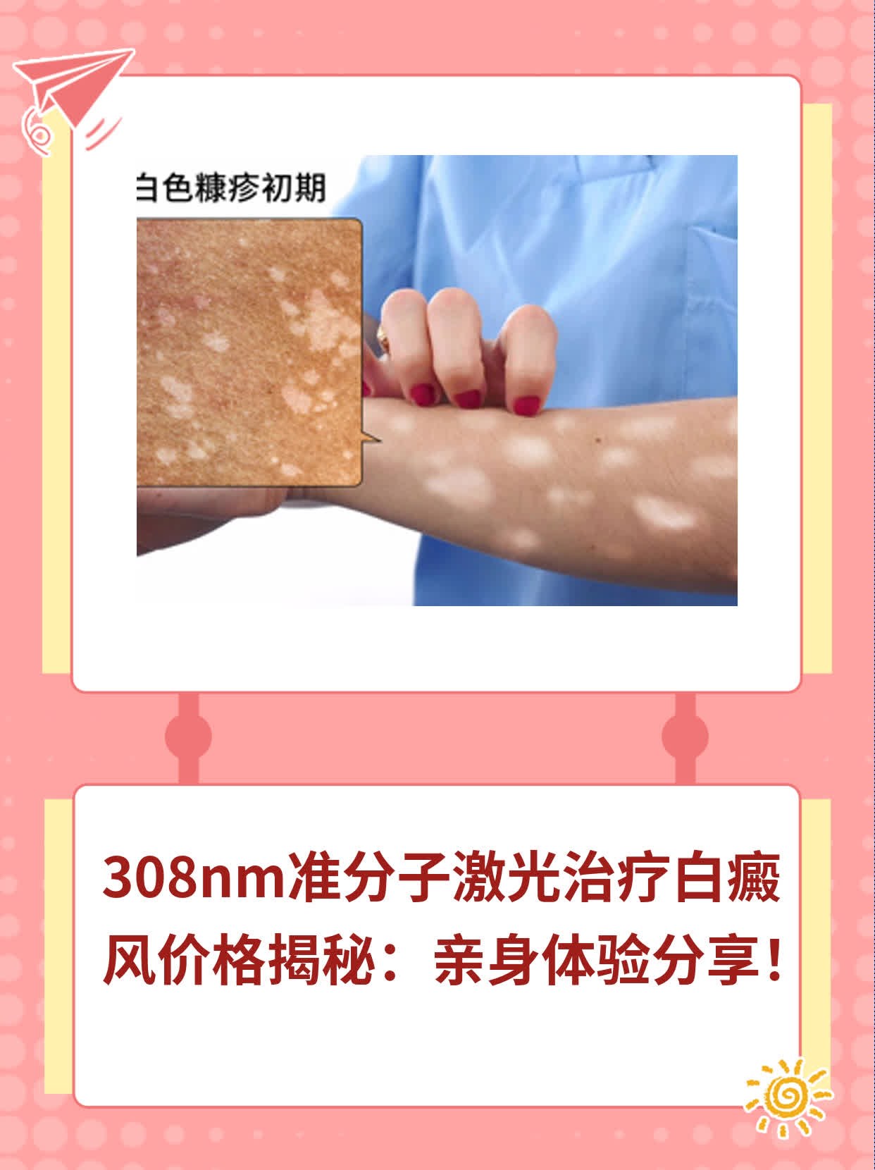 308nm准分子激光治疗白癜风价格揭秘：亲身体验分享！