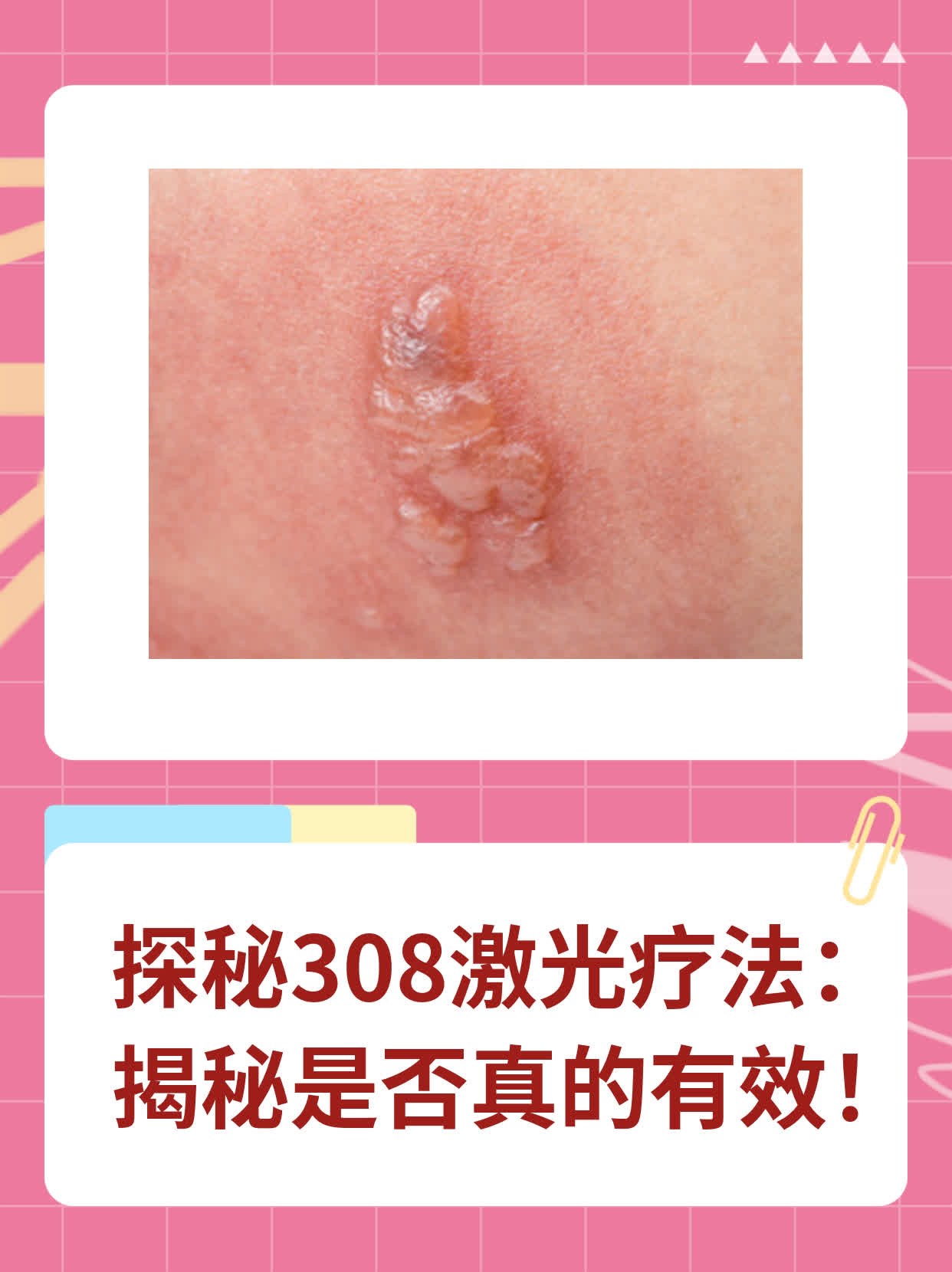 探秘308激光疗法：揭秘是否真的有效！