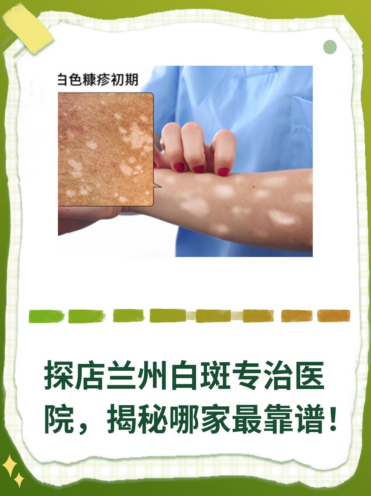 探店兰州白斑专治医院，揭秘哪家最靠谱！