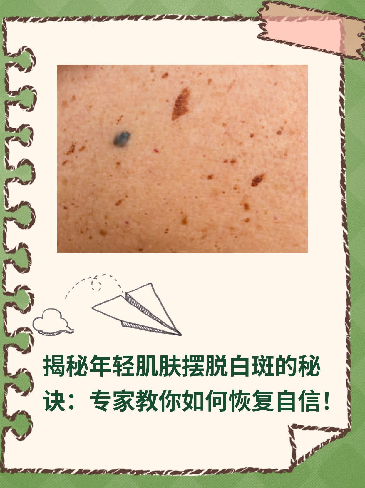 揭秘年轻肌肤摆脱白斑的秘诀：专家教你如何恢复自信！