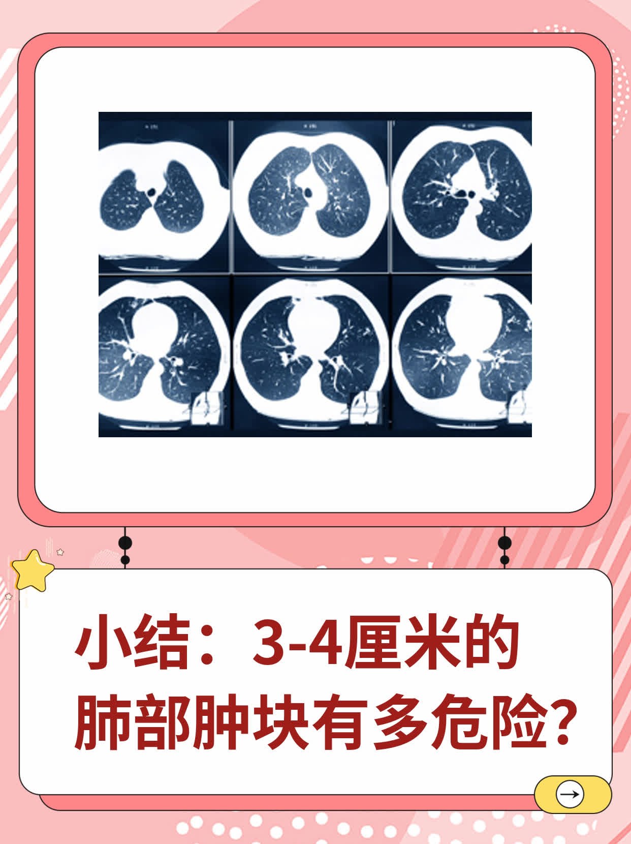 小结：3-4厘米的肺部肿块有多危险？